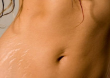 Растяжки (стрии)